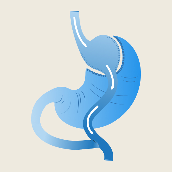 gastricBypass